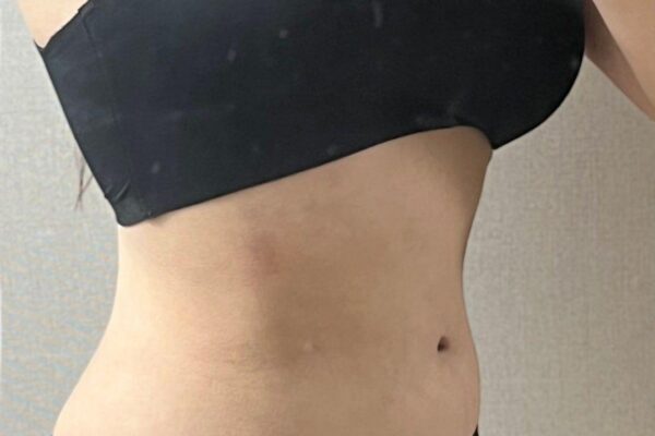 수술후 1개월차