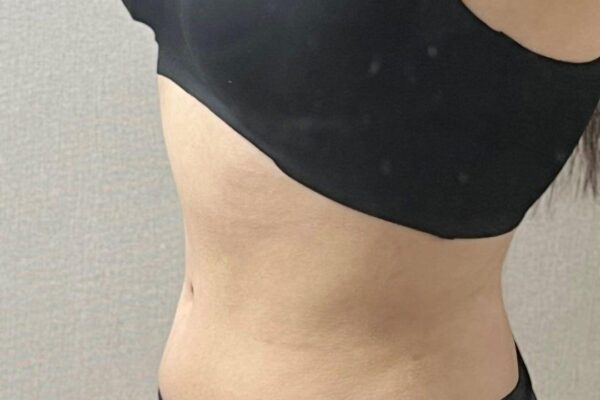 수술후 1개월차