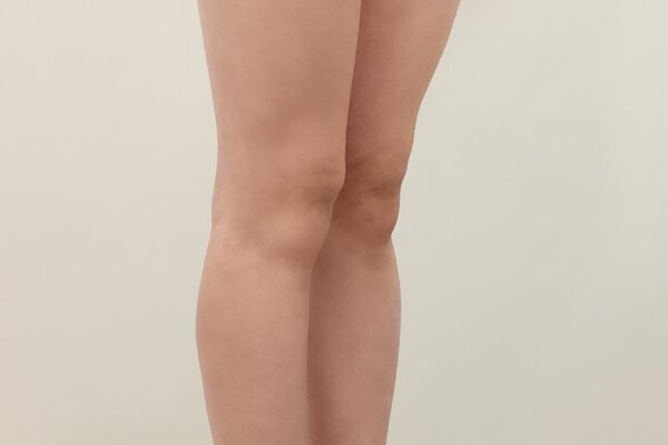 20수술전 허엉무 골반 힙딥 이식 종아리 (2)